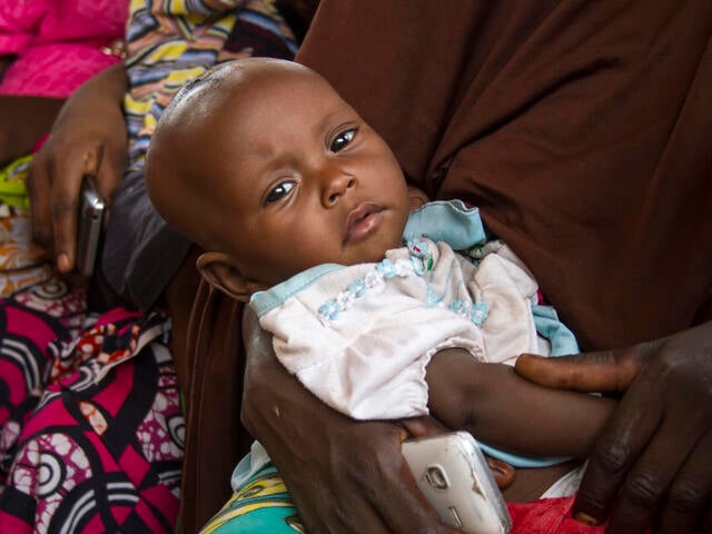 Six-month-year-old daughter Falmata, was diagnosed with severe malnutrition