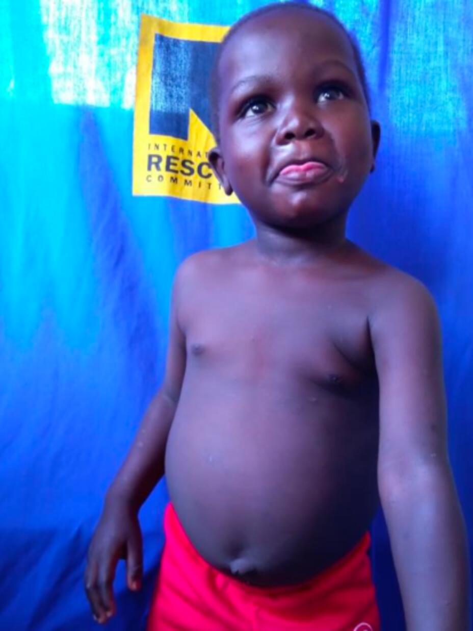Ali is one of Esther's young patients. After receiving specialised treatment and care for malnutrition and other illnesses, he has regained his health — and his smile.
