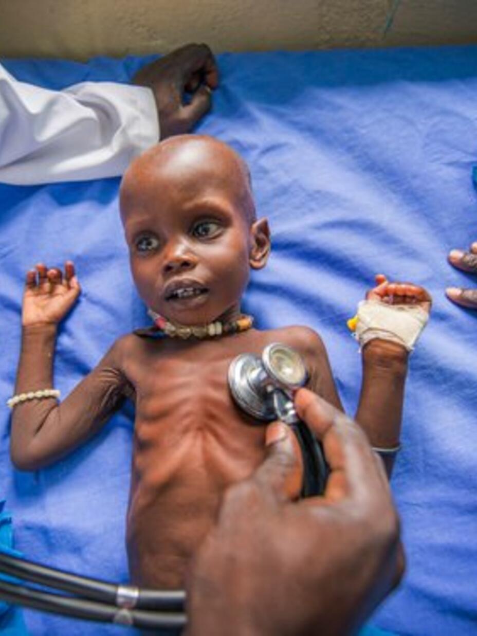 A severely malnourished boy is treated in an IRC feeding center in Ganyliel. Thousands of children could suffer from severe malnutrition as fighting continues to make it difficult for aid agencies to deliver lifesaving assistance.