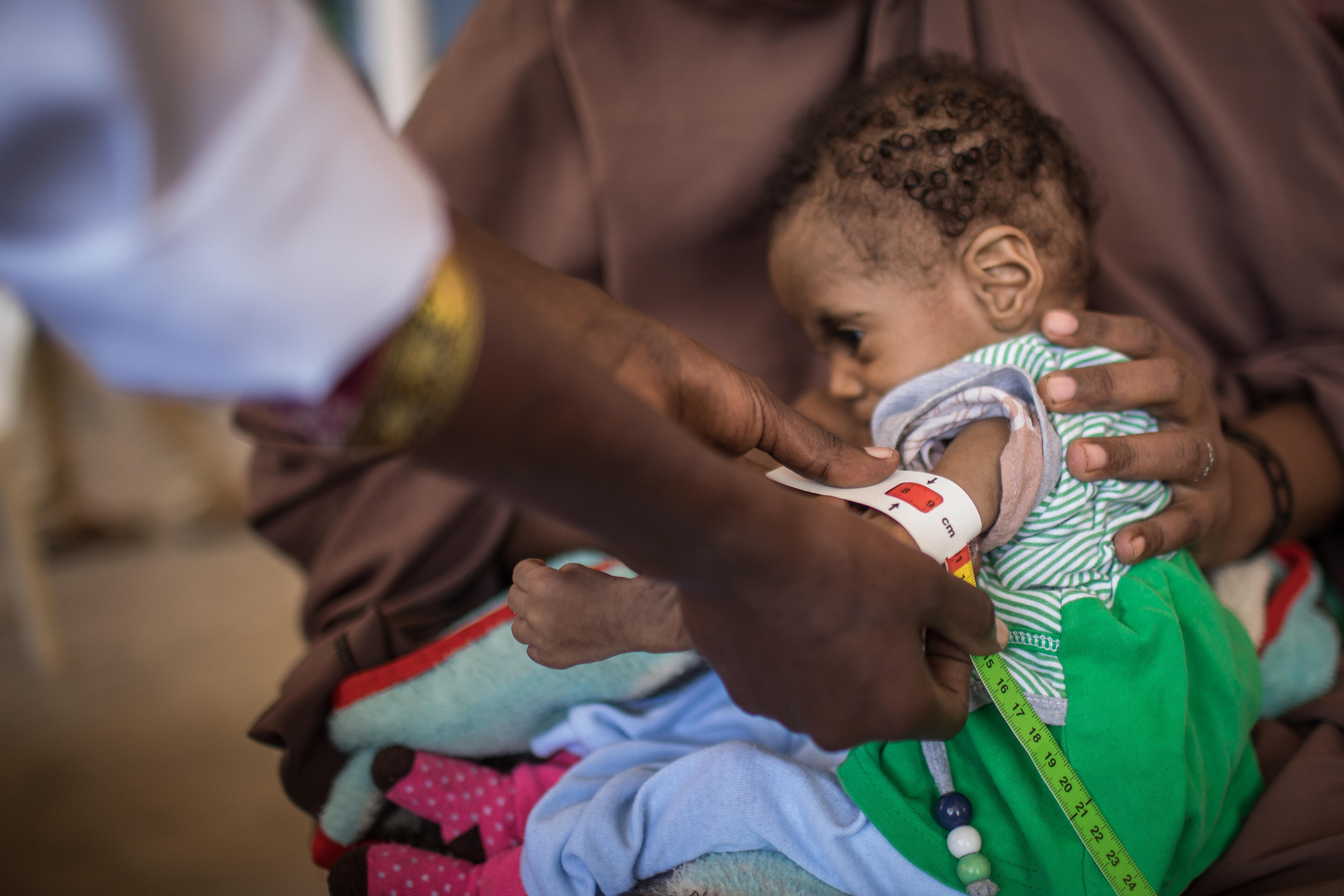 A young Somalian child is examined for nutrition