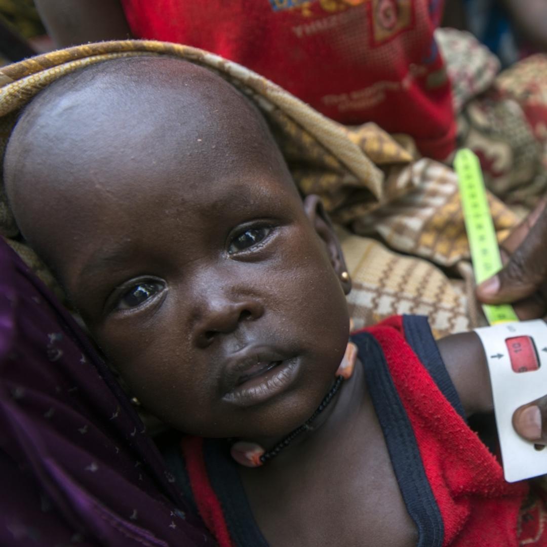 in South Sudan, a baby boy's arm is measured with a specially designed tape for signs of malnutrition.