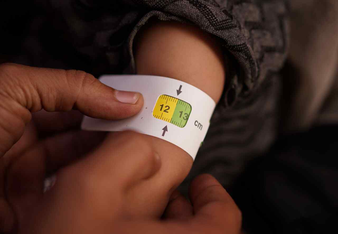 Photo story: A mobile health team treats malnutrition in Yemen | The IRC