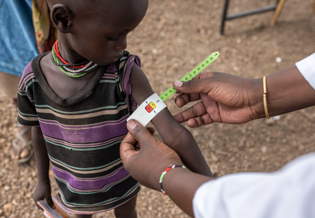A boy in Kenya treated by a nutritionist for malnutrition near RukRuk village in Turkana, Kenya