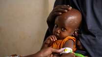  Two-year-old Mowlid eats a high protein peanut paste, also known as ready-to-use therapeutic food (RUTF), as treatment for his severe acute malnutrition. As part of our simplified approach, the IRC recommends providing RUTF as the primary treatment product for all children diagnosed with acute malnutrition. 