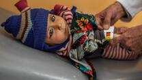 A baby bundled up in winter clothing lies on an examination table while an adult measures his arm using a special device used to diagnose malnutrition. 