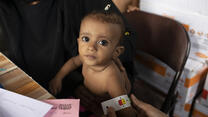 A small child being examined at an IRC clinic in Yemen has her upper arm measured with a MUAC tape, which shows she may be acutely malnourished.
